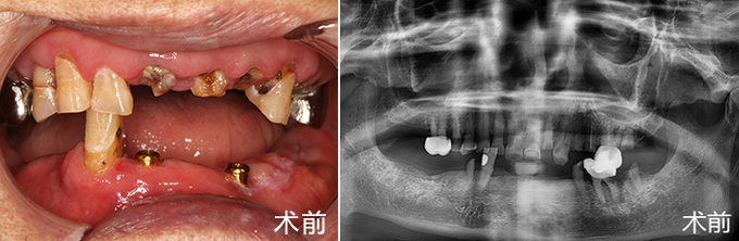 種植牙術(shù)前照片和牙片