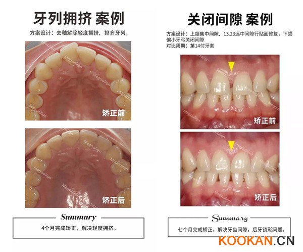 這樣的牙齒都適合用易齊微矯正