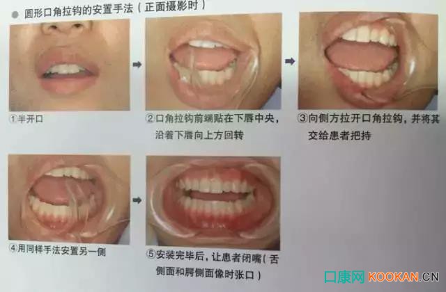 拍不好口腔照片怎么辦？這些口腔攝影方法與技巧請(qǐng)收好！