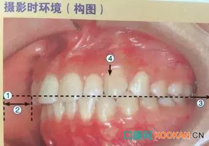 拍不好口腔照片怎么辦？這些口腔攝影方法與技巧請(qǐng)收好！