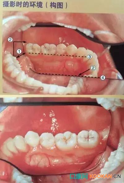 拍不好口腔照片怎么辦？這些口腔攝影方法與技巧請(qǐng)收好！