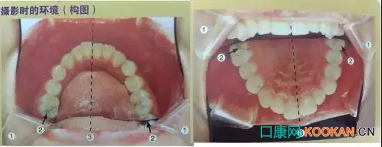 拍不好口腔照片怎么辦？這些口腔攝影方法與技巧請(qǐng)收好！